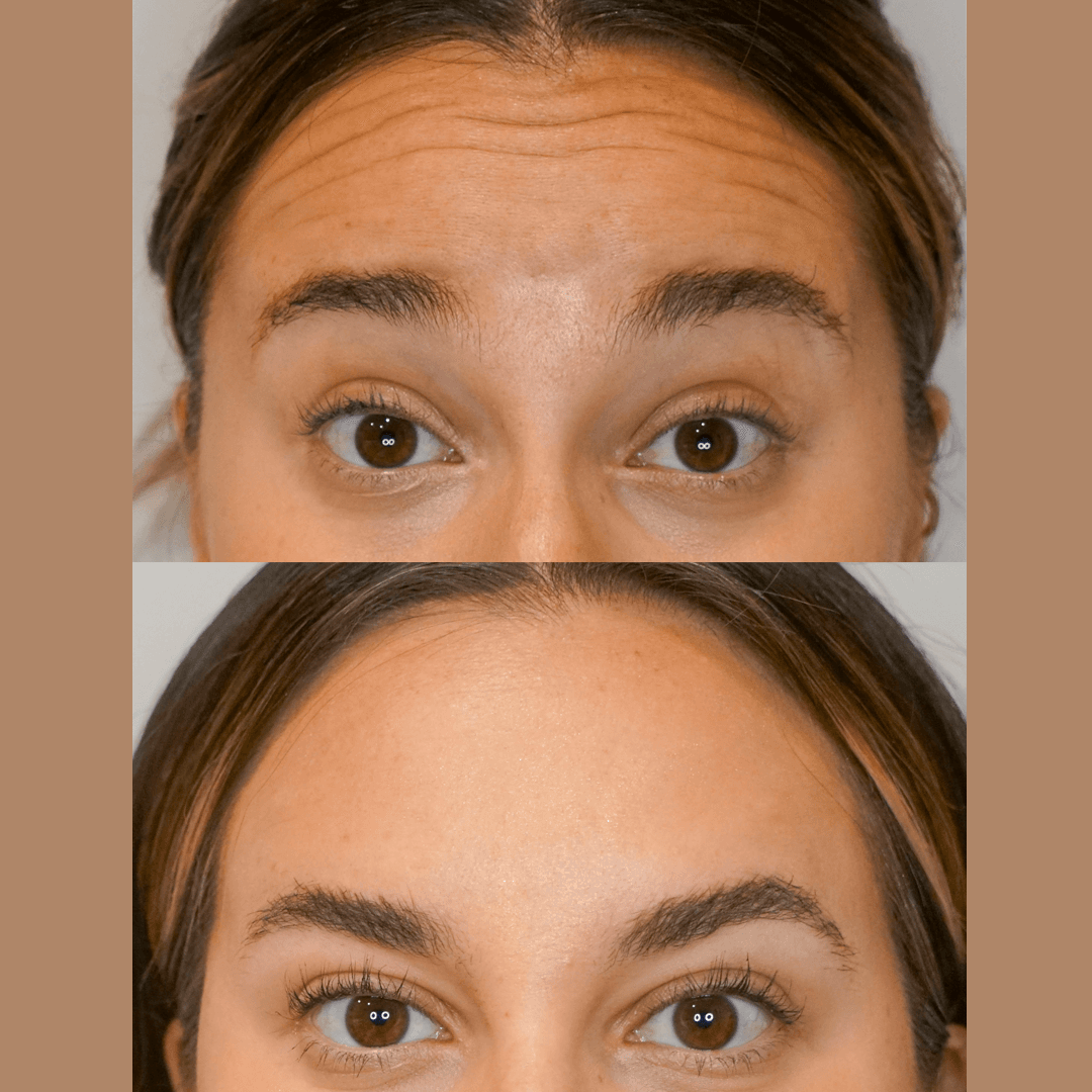 gina_forehead_botox_ba (5).png