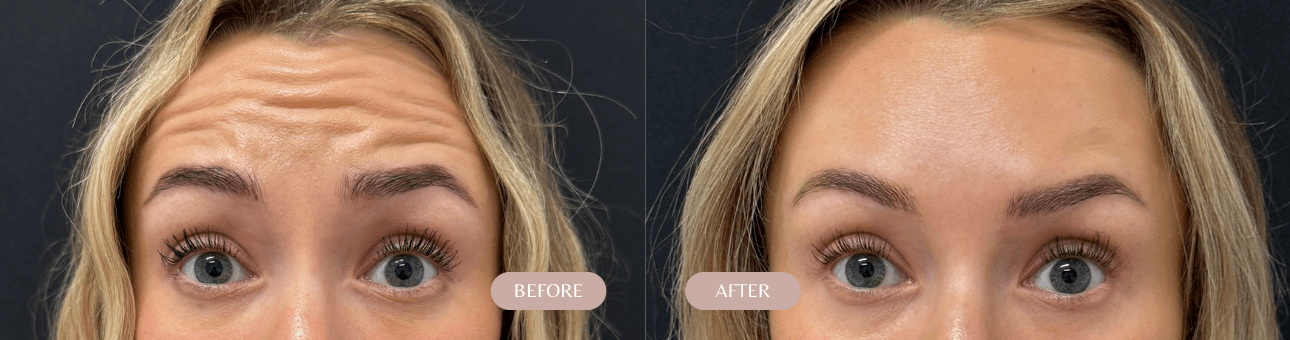 Botox Before & After