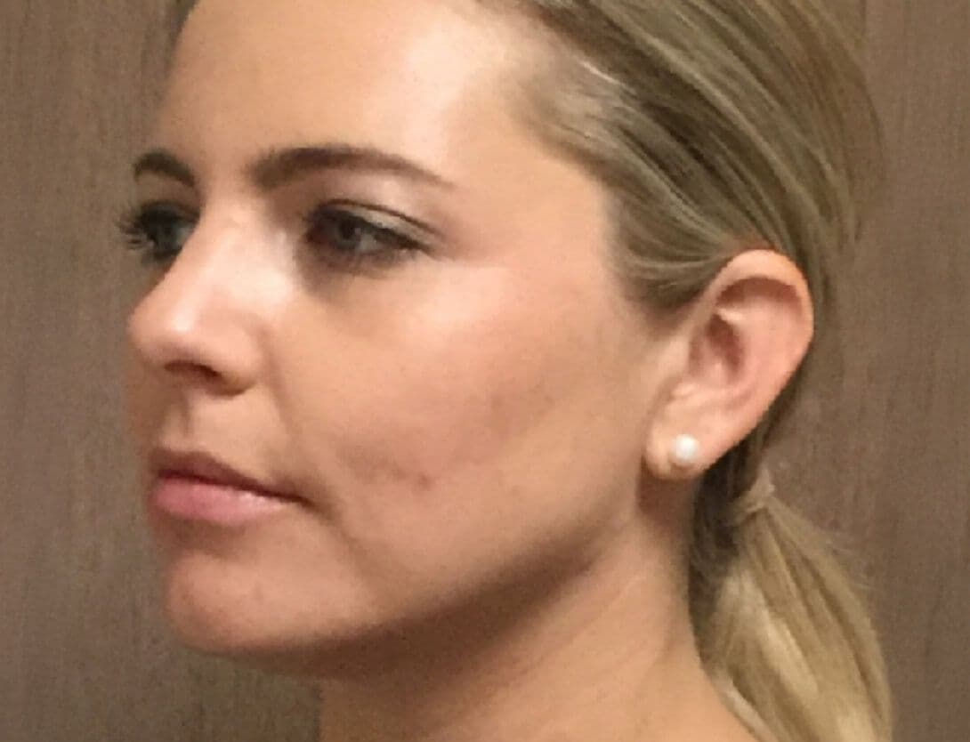 kybella-After.jpg