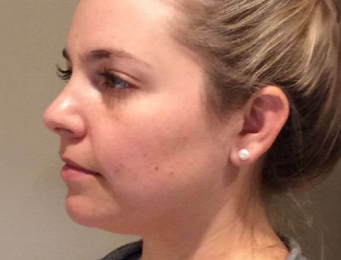 kybella-Before.jpg