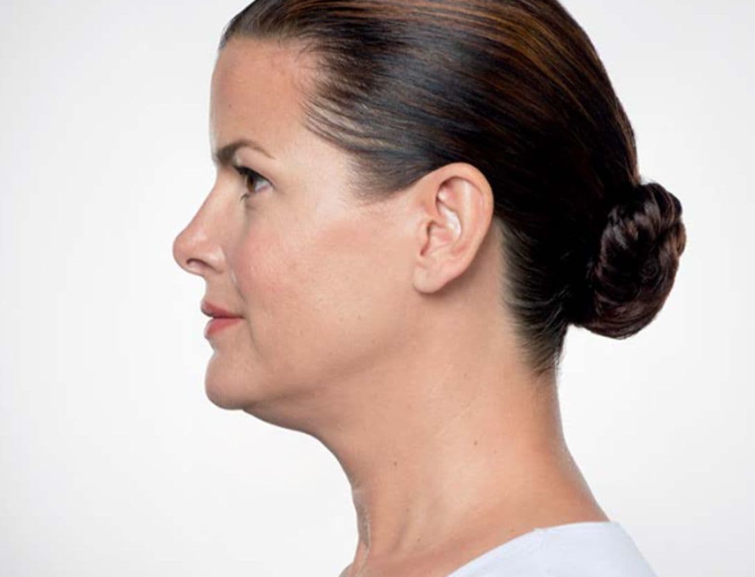 kybella-before(1).jpg