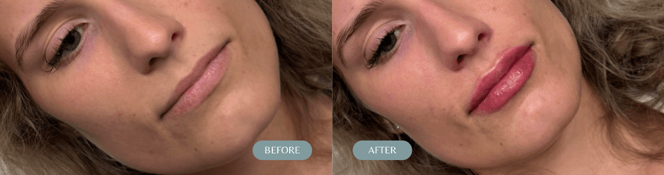 Lip Filler Before & After