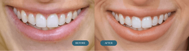 Lip Flip Before & After