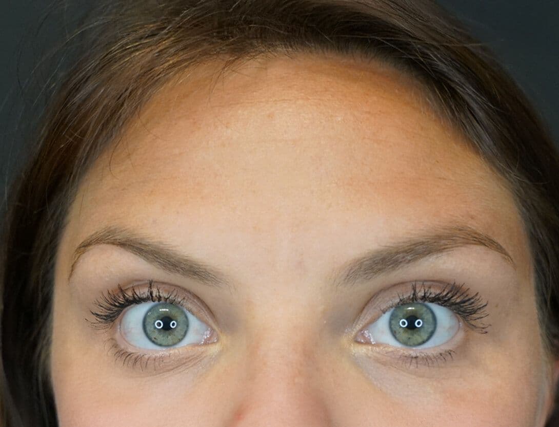 sarah_botox_forehead_After.jpg