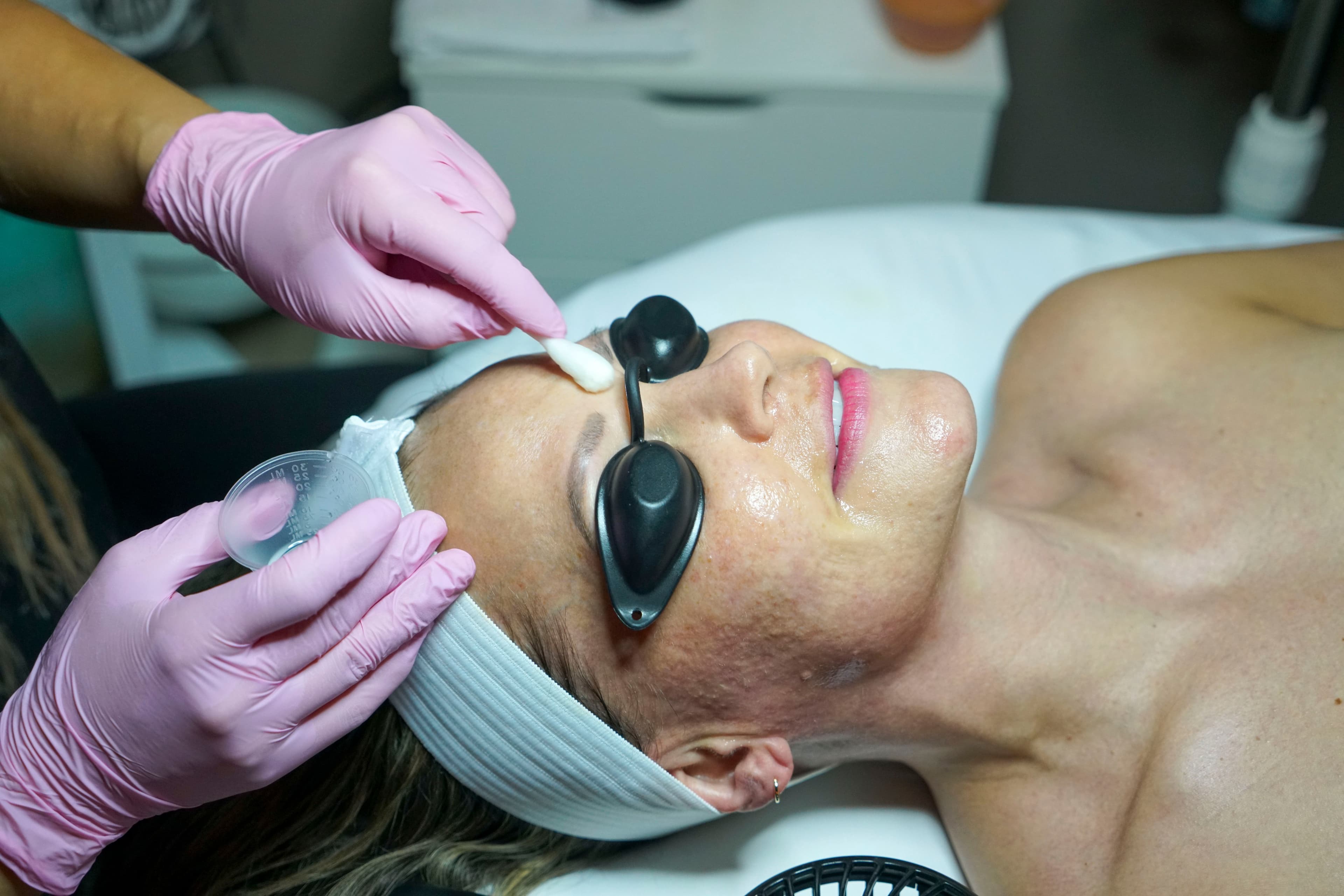 skinceuticals_tca_peel_6.JPG