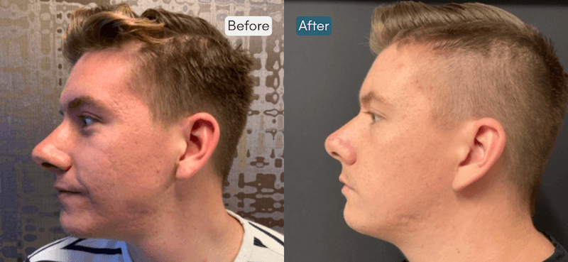 Morpheus8 for Acne Scarring