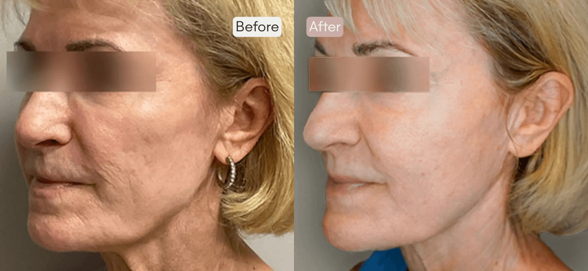 Before and After 3 Sessions of Morpheus8 Face + Neck