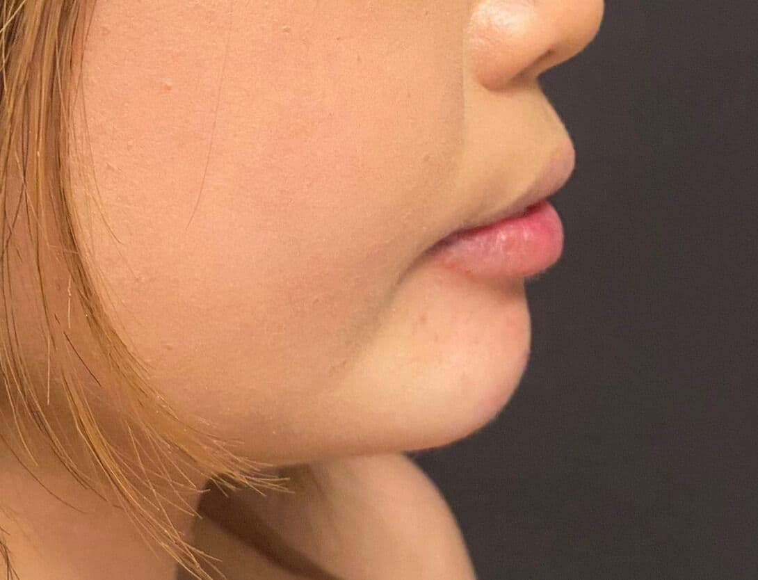 Brittany Javier; chin and lower lip filler with Voluma and Contour 3-After.jpg