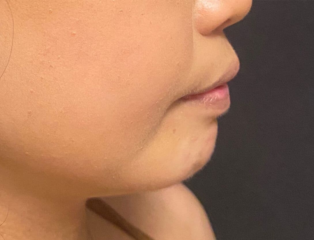 Brittany Javier; chin and lower lip filler with Voluma and Contour 3-Before.jpg