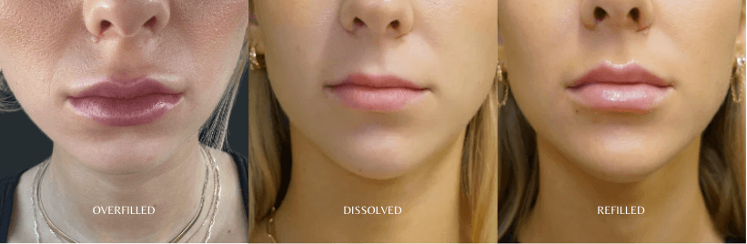 Jenni Lip Filler Transformation