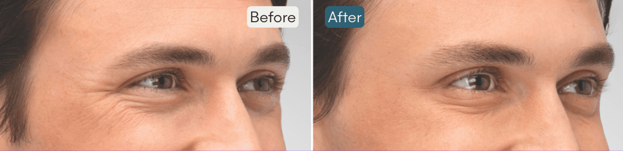 Men's Botox Before and After