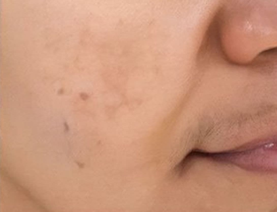 Close up image of woman's skin before mesotherapy