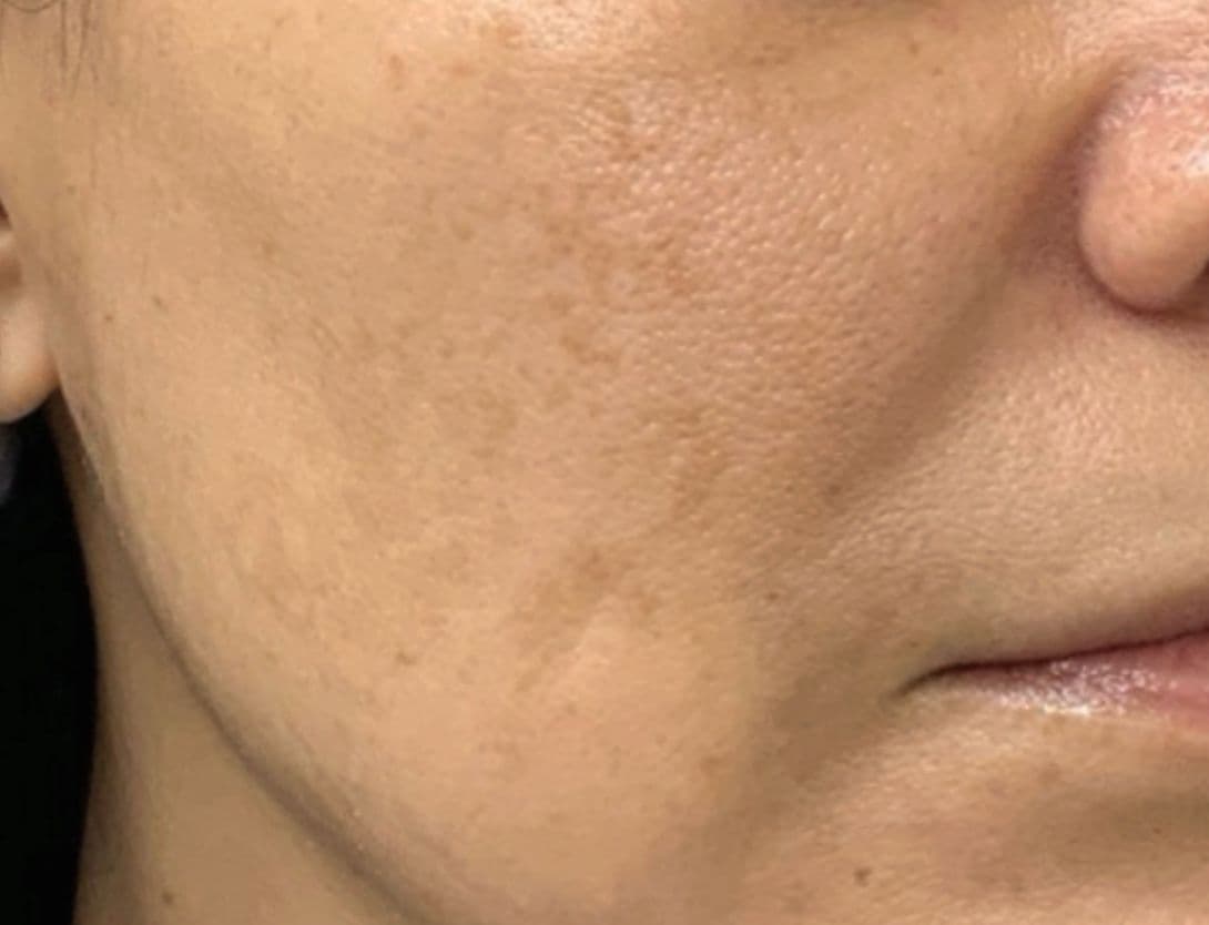 Close up image of woman's skin after mesotherapy treatment with hyperpigmentation resolved
