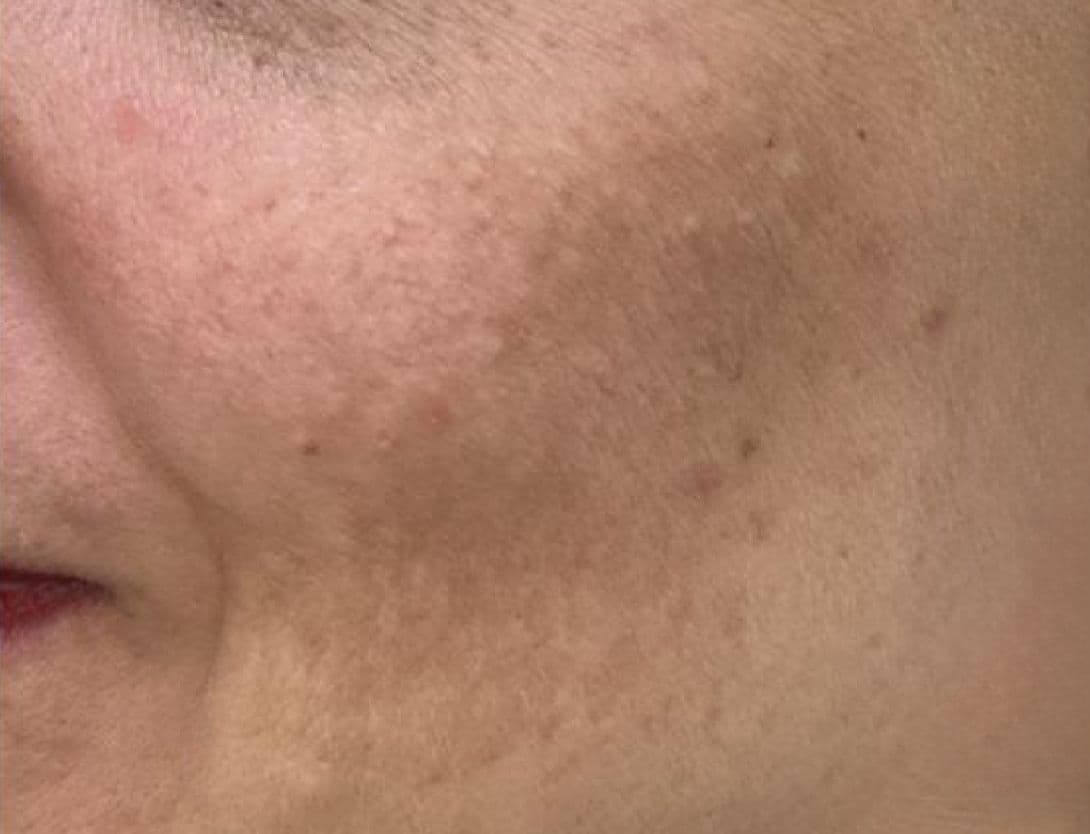 Close-up of woman's face after Mesotherapy