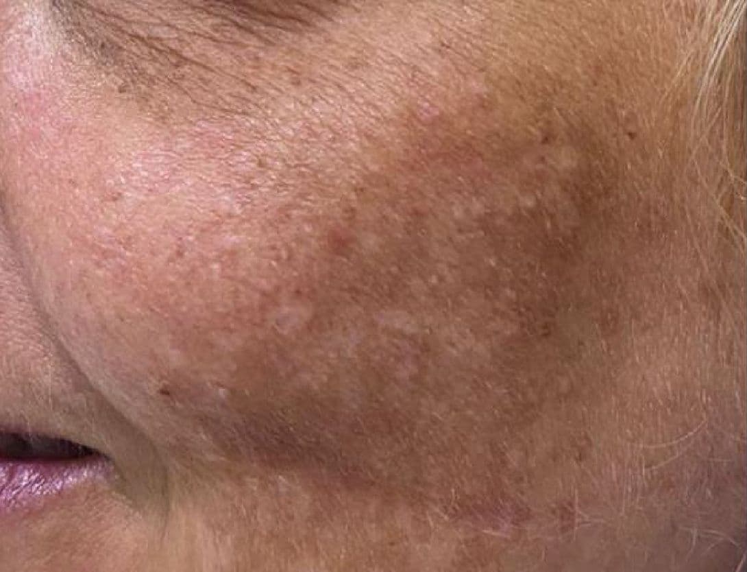 Close up image of woman's skin before mesotherapy