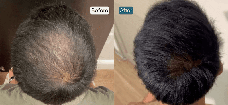 Men's PRP Hair Restoration