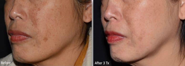 Resurface-Refine-Laser-Facial-Laser-Skin-Services-Revive-Med-Spa-8.jpg
