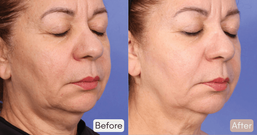 XERF Before & After