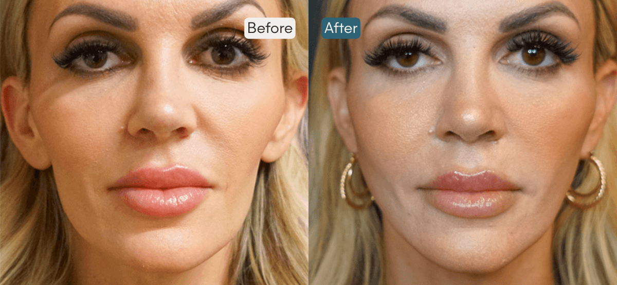 Before and After Sculptra