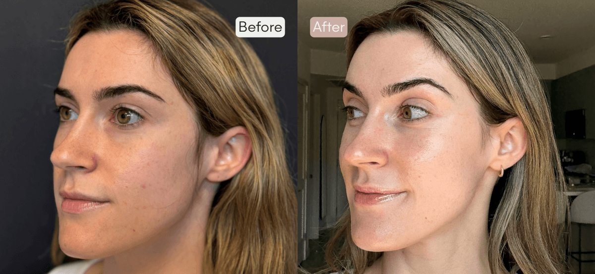 Before and After 3 Sessions of Microneedling