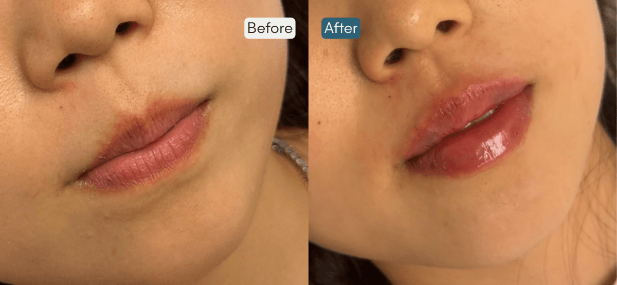 Before and After Filler